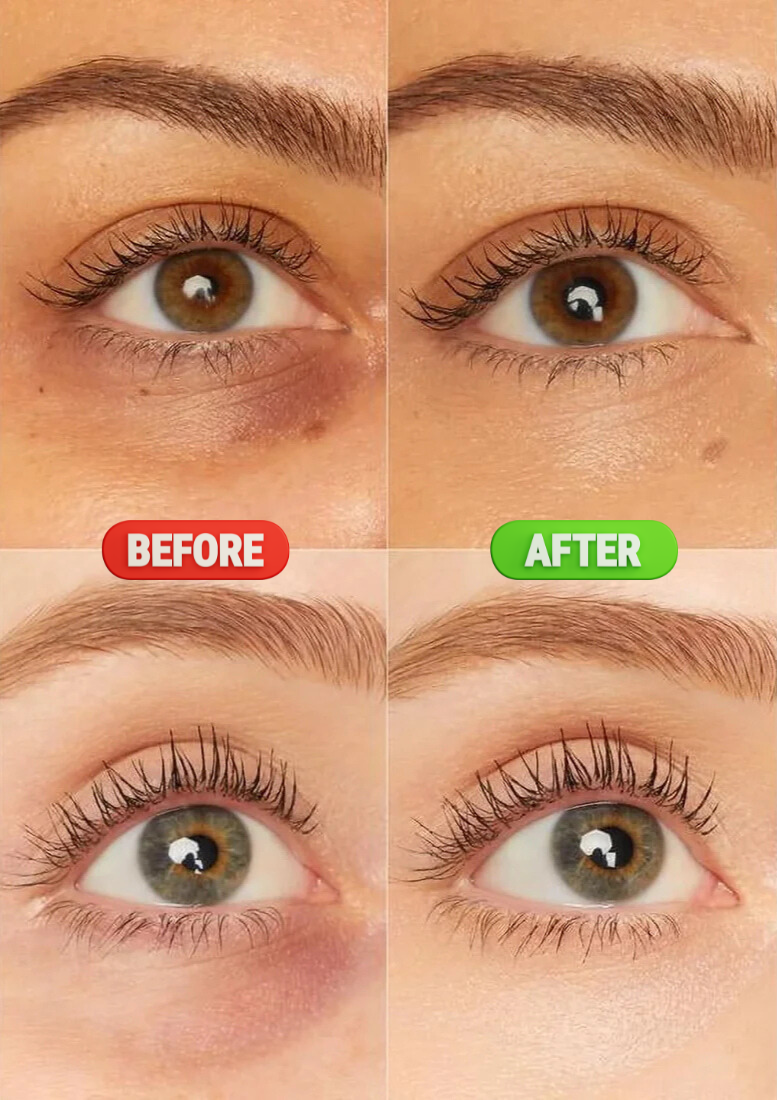 Hydreva™- Hydrogel Eye Patch